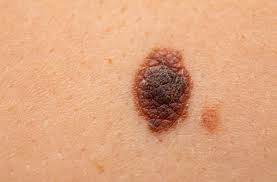 Risk factors include having multiple. How To Spot Cancerous Moles Health Essentials From Cleveland Clinic