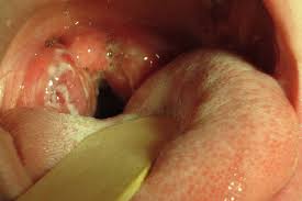 Image result for Strep throat infection roof of mouth