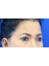 Endoscopic Forehead Lift in Orange, CT
