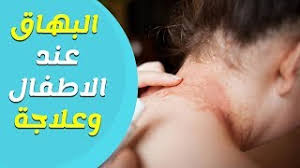 اعراض البهاق عند الاطفال والرضع وطرق العلاج والوقاية youtube