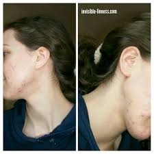 Some women also notice breakouts around the time of ovulation. Being Vulnerable My Painful Struggle With Hormonal Acne