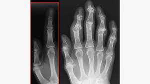 Image result for XRay Changes in Rheumatic Conditions