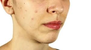 Cara Menghilangkan Flek Hitam Di Wajah Yang Membandel Secara Alami Dengan Cepat Beauty Fimela Com