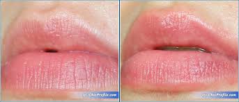 Pmd Kiss Lip Plumping System Review Before After Beauty Trends And Latest Makeup Collections Chic Profile
