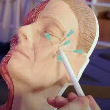 Tutorial: injection points for cheek filler