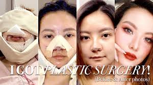 Many patients go into surgery in the afternoon and are therefore required to go 18 hours without food and drink under the old standards. I Got Plastic Surgery In Korea Part 2 Before After Surgery Recovery Emily Quak Youtube