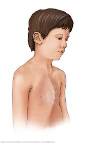 It is less common than pectus excavatum. Pectus Carinatum Symptoms And Causes Mayo Clinic