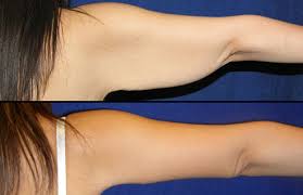 Can you lose arm fat in a week. Best Exercises To Lose Arm Fat In Just One Week