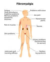 fibromyalgia tender points