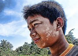 Ubat tradisional sememangnya kaya dengan nutrien, serta kebolehannya untuk mengubati giling dan kemudian sapu. 3 Petua Tradisional Hilangkan Panau Dengan Mudah Dan Berkesan