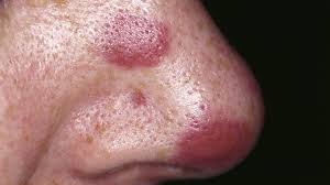 Throughout this article, we have provided images of how different rash might cause the skin to appear. Hiv Rash What Does It Look Like And How Is It Treated