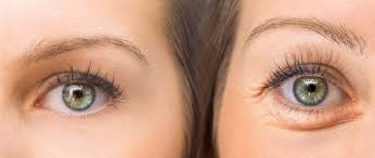 Das Sagen Geschwollene Augen Uber Die Gesundheit Aus Rpr1