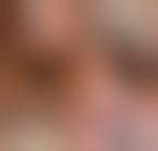 Image result for conjunctival melanoma