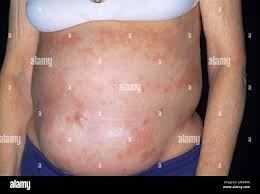 Image result for Splenomegaly