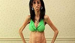 Check spelling or type a new query. 5 Skinniest People Skinniest People Ever In The Word Fans Lite