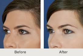 How much is a brow lift botox. How To Get A Brow Lift Without Surgery Lasting Looks