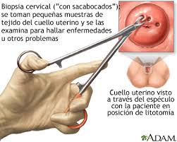 O câncer de colo uterino pode ser detectado muito precocemente. Cancer Cervical Medlineplus Enciclopedia Medica