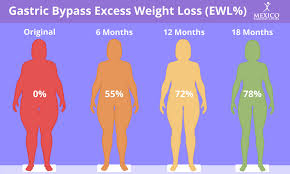 i lose with gastric byp surgery
