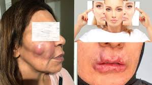 المساء - عمليات "الفيلر" و"البوتكس" بمراكز التجميل.. مجازفة خطيرة