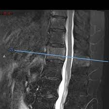Search to find out more about picture frame vertebra Paget Disease Of The Vertebral Body Radiology Case Radiopaedia Org