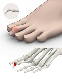 Image result for Hammer toe