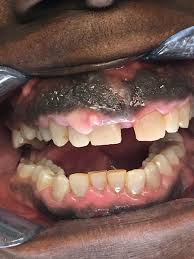 Gingivitis, or bleeding, inflamed gums, is the first stage of gum disease, usually caused by plaque buildup under the gumline. Black Gums Dark Gums Loop Perio