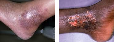 Image result for Stasis Dermatitis