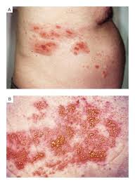 Image result for herpes zoster