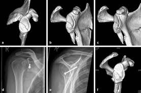354 likes · 2 talking about this. Intraartikulare Frakturen Sciencedirect