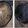 The amount of hair regrowth depends on each individual and can vary significantly. 1