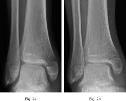 Nevertheless, three of five reported cases with combined medial. Medial Malleolar Fractures The Bone Joint Journal