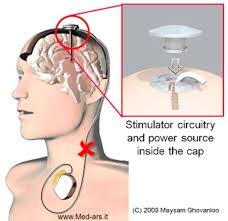 Dbs For Parkinson S Disease Low Power Head Mounted Deep Brain Stimulator Repinned By Drbrunogallo Deep Brain Stimulation Parkinsons Disease Parkinsons