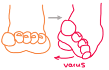 Clubfoot is a congenital condition (present at birth) that causes a baby's foot to turn inward or downward. Clubfoot Wikipedia