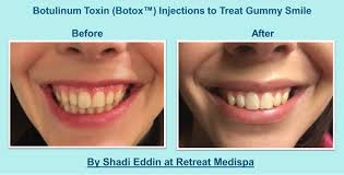 Do you feel conscious about a gummy smile? How To Treat Gummy Smile With Botox