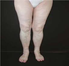 🍀 mănâncă turmeric în fiecare zi! Limfologia Edemul De Cauza Venoasa