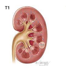 The sooner they notice any changes, the better their prognosis is likely to be. Kidney Cancer Symptoms Diagnosis Treatment Urology Care Foundation