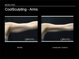 Coolsculpting + upper arms q&a. Before After Photos Of Coolsculpting Treatment Results