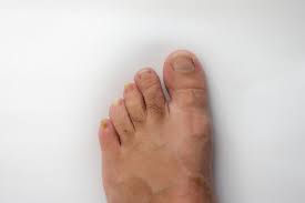 Image result for Onychogryphosis feet