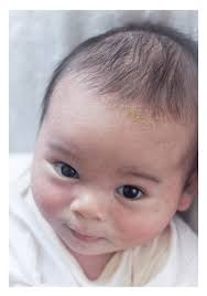 Image result for Cradle Cap