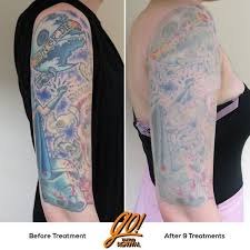 For a spokane med spa that offers laser tattoo removal, body sculpting, and skin rejuvenation, contact premier body and laser now! Pin On Tattoo Removal In Progress