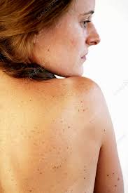 Image result for Freckled skin