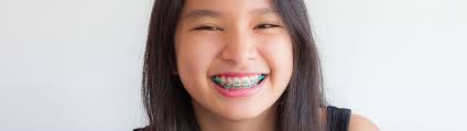 🥇 Braces Care