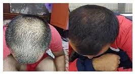 We are based in london. Hijama Cupping Center