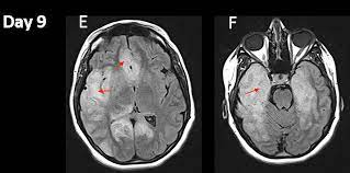 Misra uk, hashmi aa, kalita j. Cureus Fulminant Herpes Simplex Virus Type I Encephalitis Despite Maximal Medical Therapy