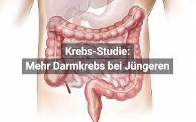 Studie Mehr Darmkrebs Bei Jungeren Menschen Praktischarzt At