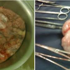 The Large 8 9 Kg Fibroid And Its Pedicle Site Left And