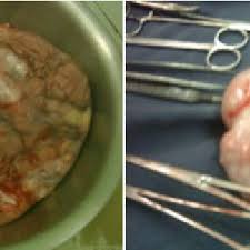 the large 8 9 kg fibroid and its pedicle site left and