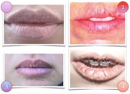 Lip twitching is a major symptom of hypoparathyroidism. Tcm Diagnosis Lips Observation Acupro Academy Acupuncture Online Courses