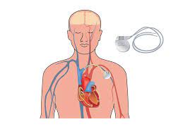 How close must a magnet be to a pacemaker to affect its operation? Protecting Implantable Medical Devices From Electromagnetic Interference Passive Components Blog