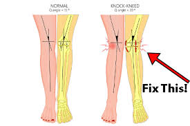 Hell, you can even go to a public place and examine people's walking. Shoes For Women With Knock Knees Improve The Way You Walk Comfortable Women S Shoes